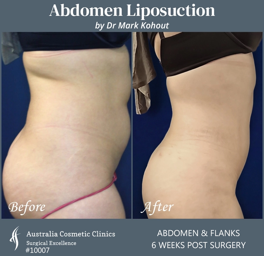 Abdomen Liposuction Patient 10007 SIDE