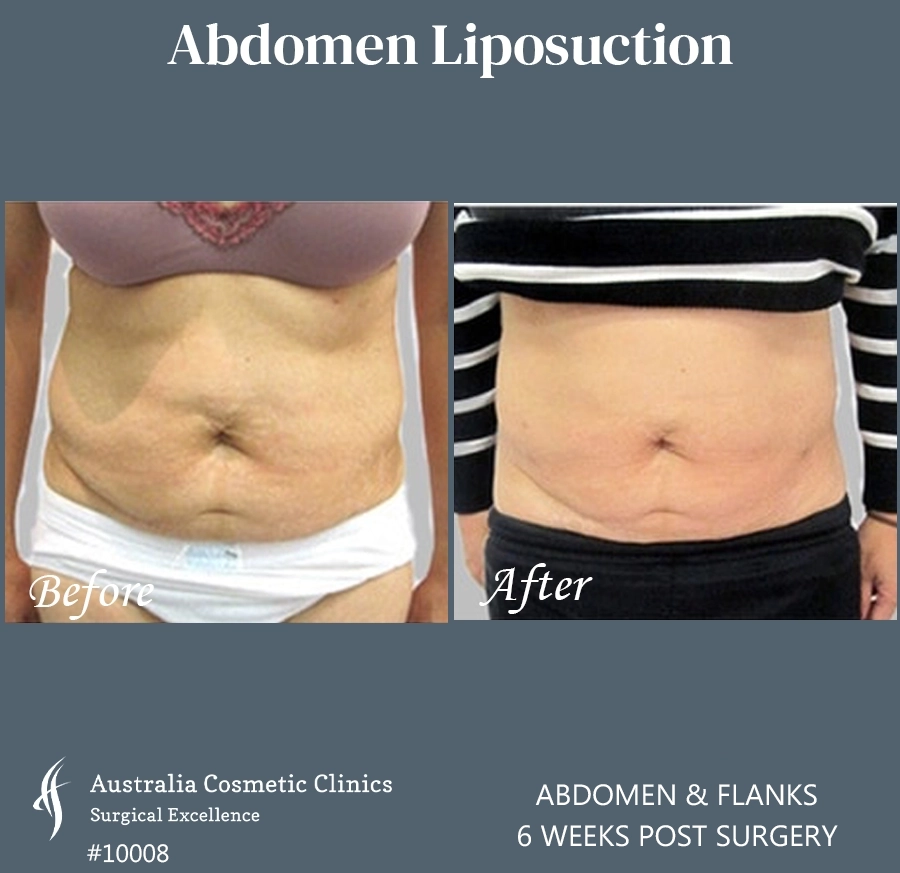 Abdomen Liposuction Patient 10008 FRONT
