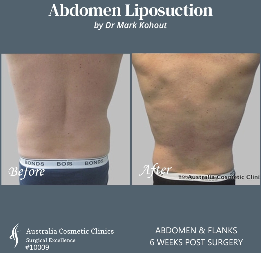Abdomen Liposuction Patient 10009 BACK