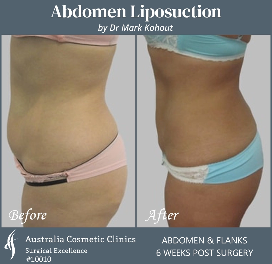 Abdomen Liposuction Patient 10010 SIDE