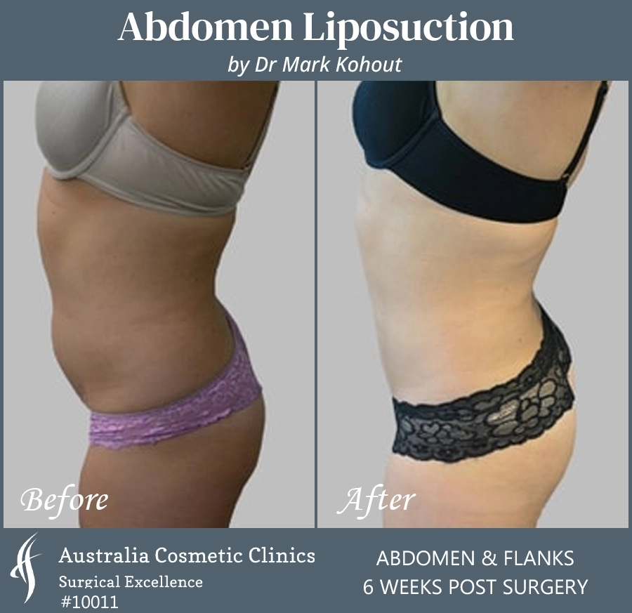 Abdomen Liposuction Patient 10011 SIDE