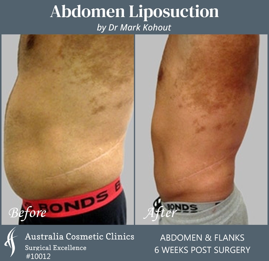Abdomen Liposuction Patient 10012 SIDE