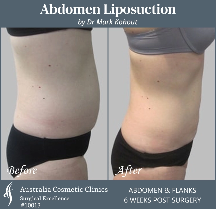 Abdomen Liposuction Patient 10013 SIDE