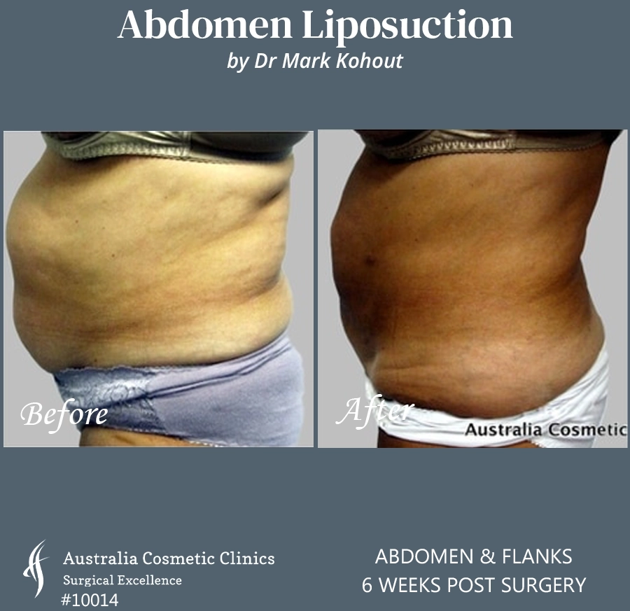 Abdomen Liposuction Patient 10014 SIDE