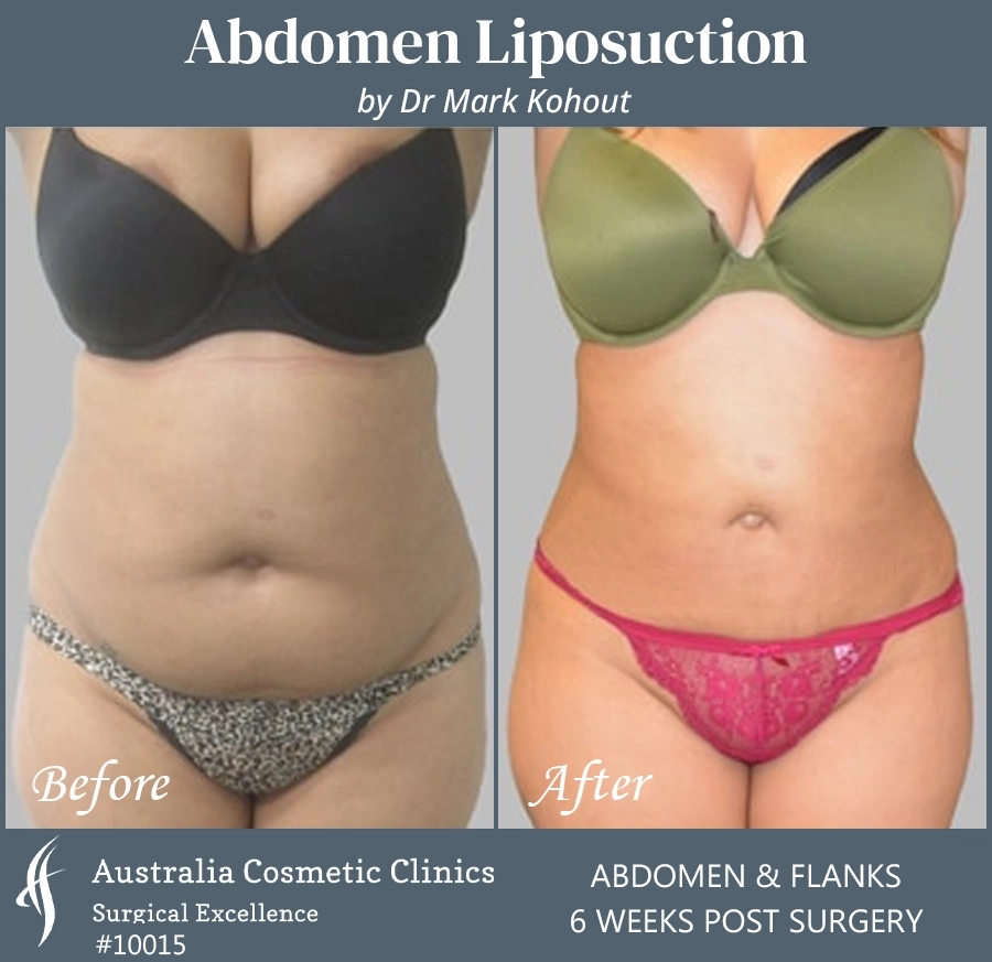 Abdomen Liposuction Patient 10015 FRONT
