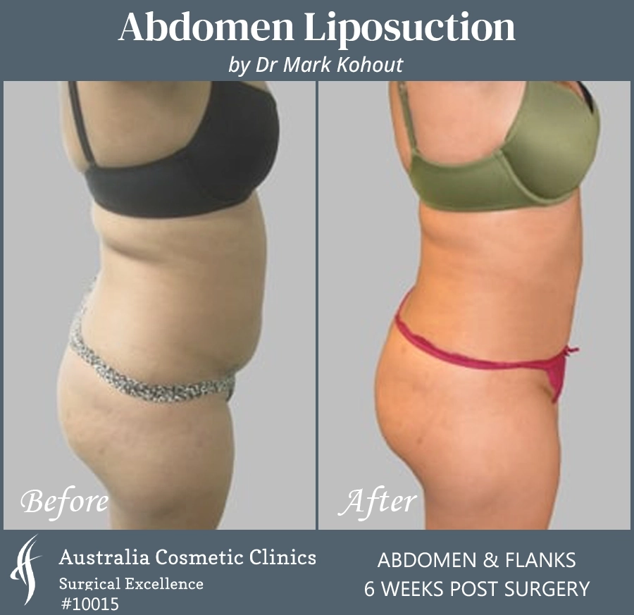 Abdomen Liposuction Patient 10015 SIDE