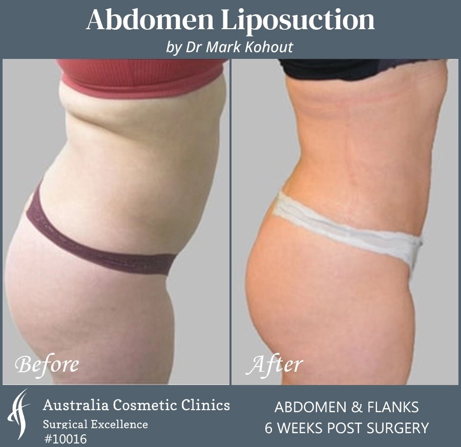 Abdomen Liposuction Patient 10016 SIDE