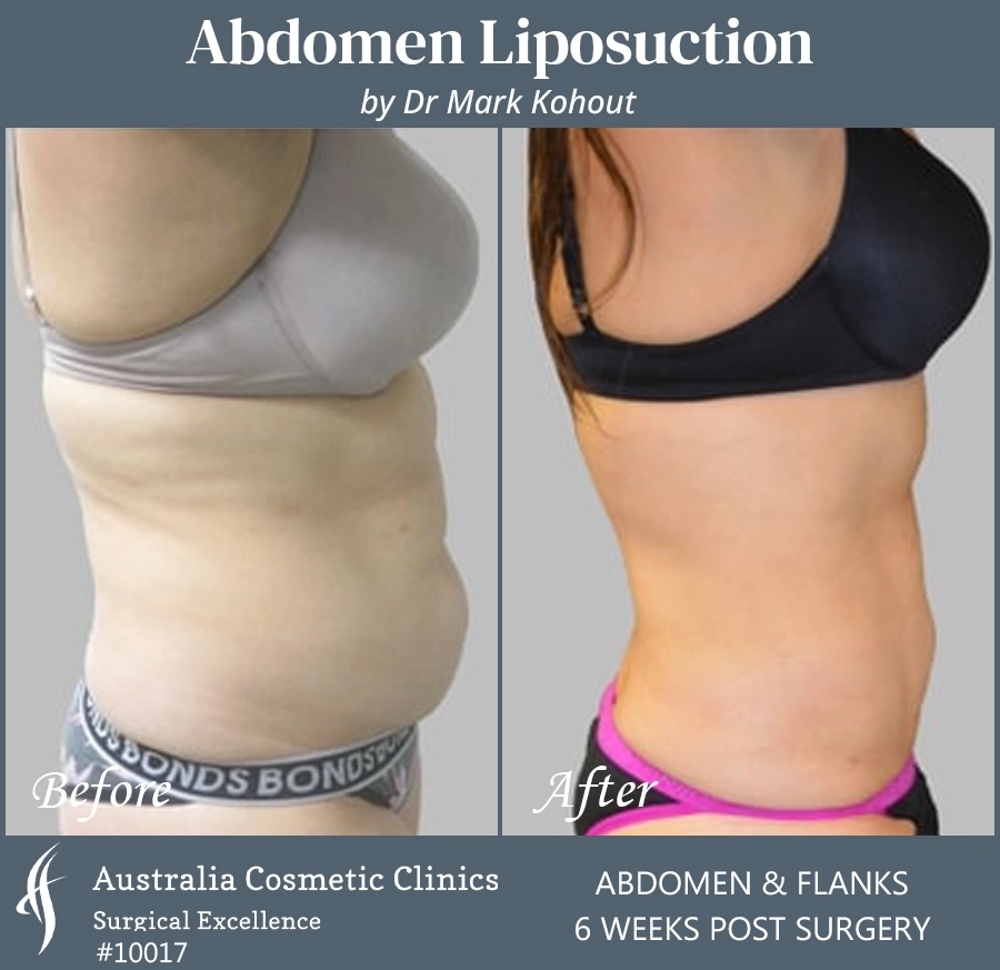 Abdomen Liposuction Patient 10017 SIDE