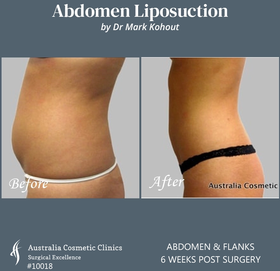 Abdomen Liposuction Patient 10018 SIDE