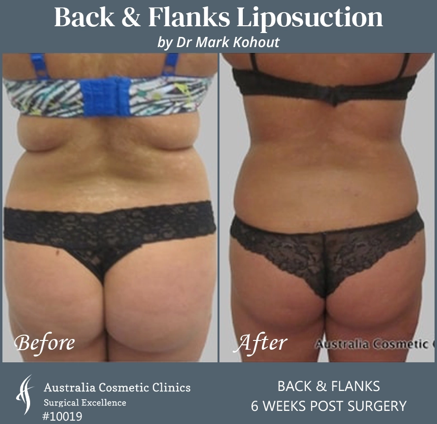 Abdomen Liposuction Patient 10019 BACK