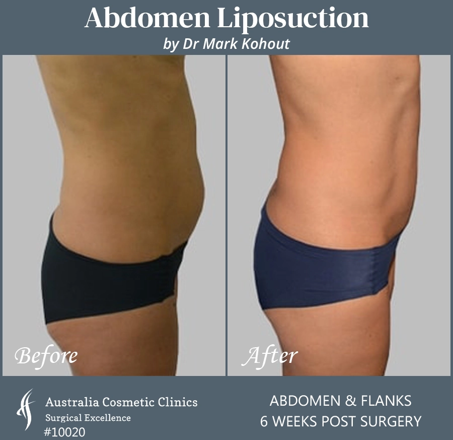 Abdomen Liposuction Patient 10020 SIDE