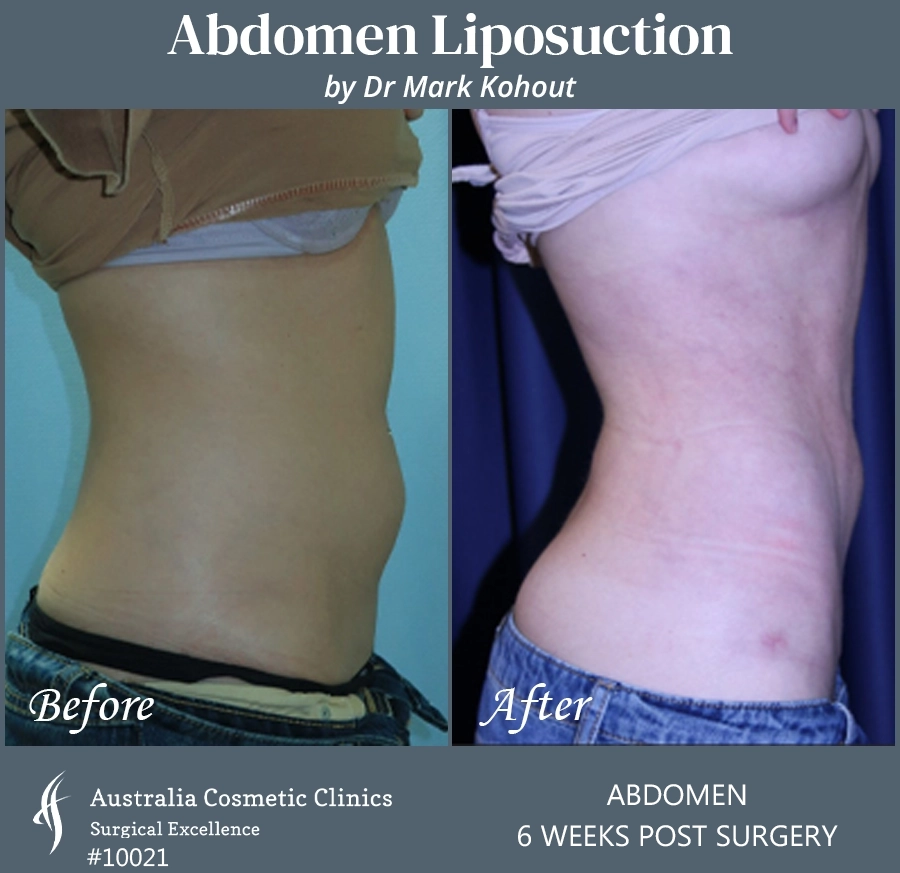 Abdomen Liposuction Patient 10021 SIDE