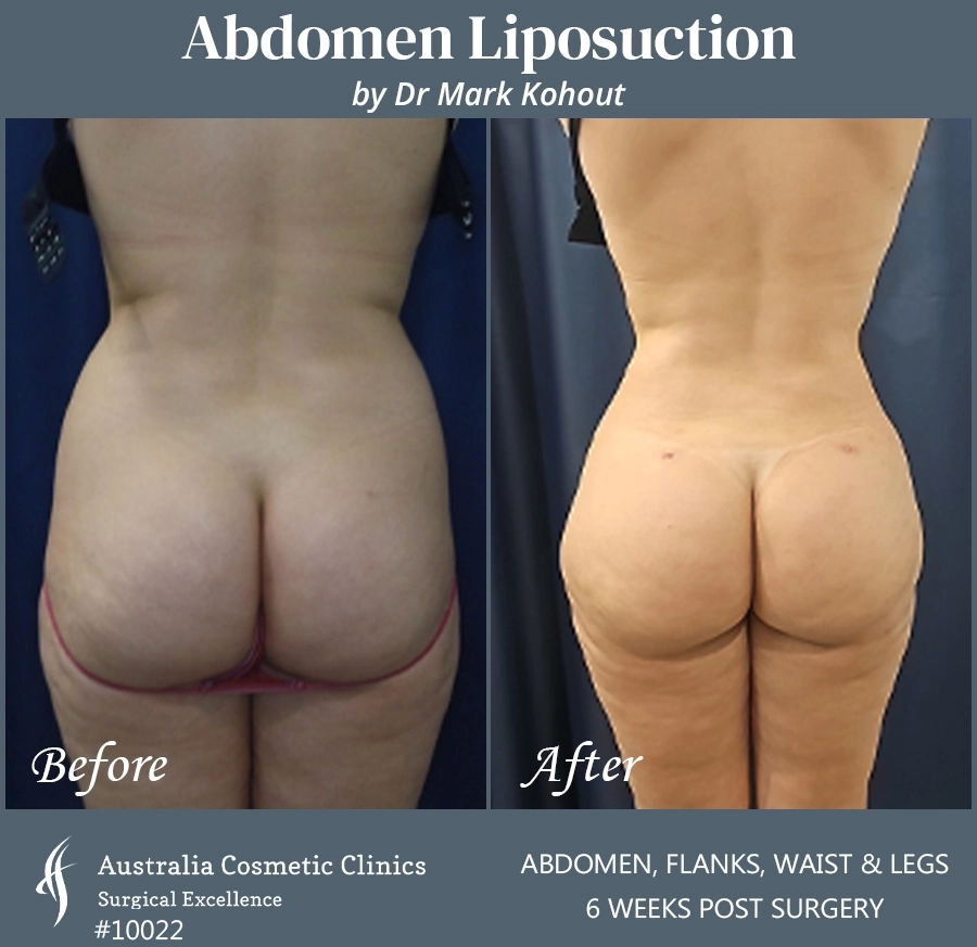 Abdomen Liposuction Patient 10022 BACK