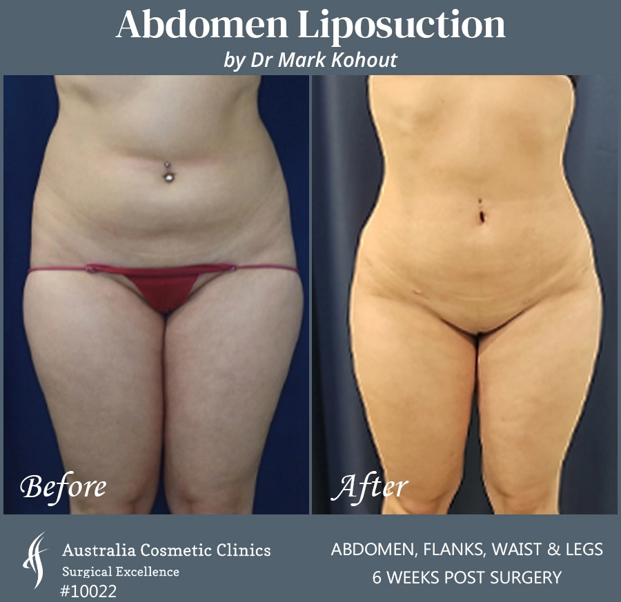 Abdomen Liposuction Patient 10022 FRONT