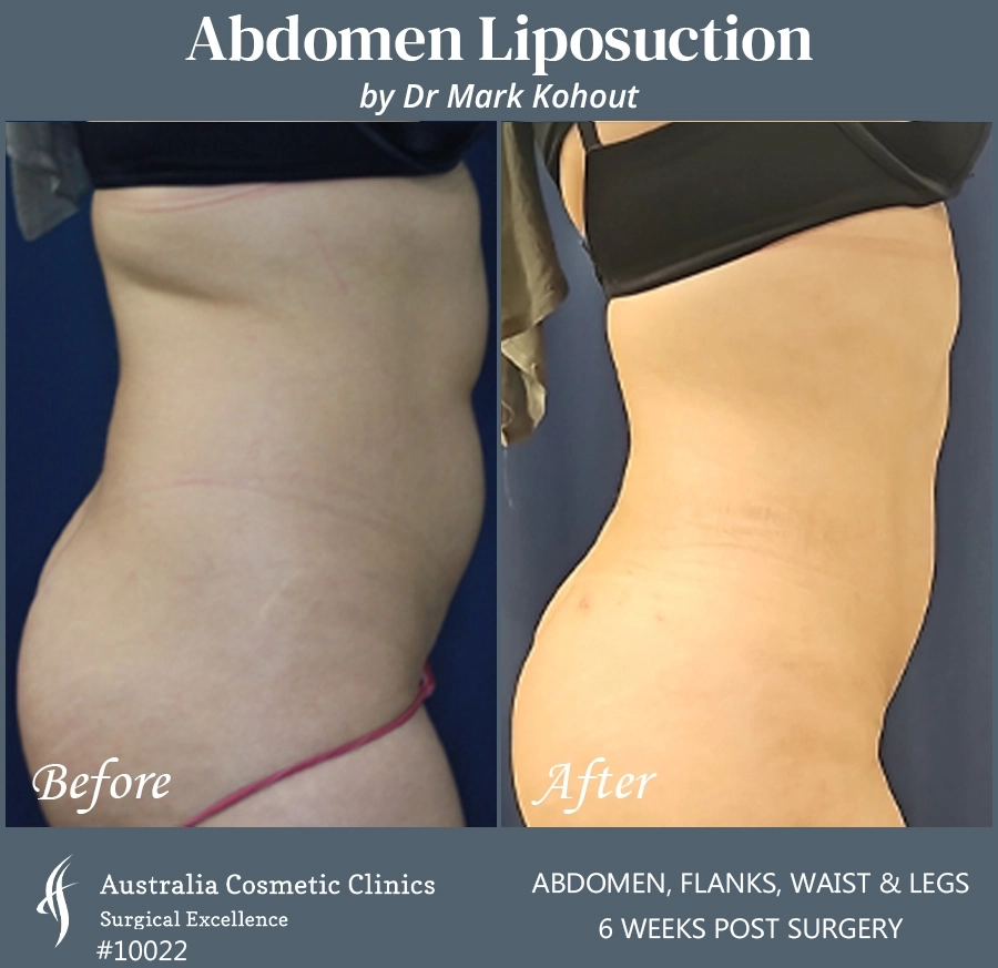Abdomen Liposuction Patient 10022 SIDE