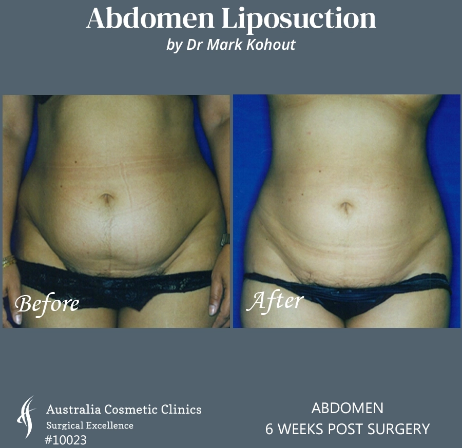 Abdomen Liposuction Patient 10023 FRONT