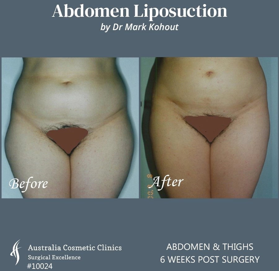 Abdomen Liposuction Patient 10024 FRONT