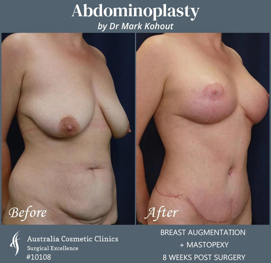 Abdominoplasty Patient 10108 45