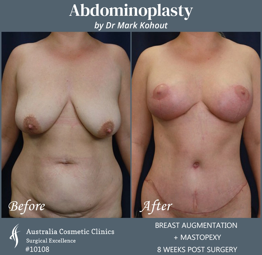 Abdominoplasty Patient 10108 Front