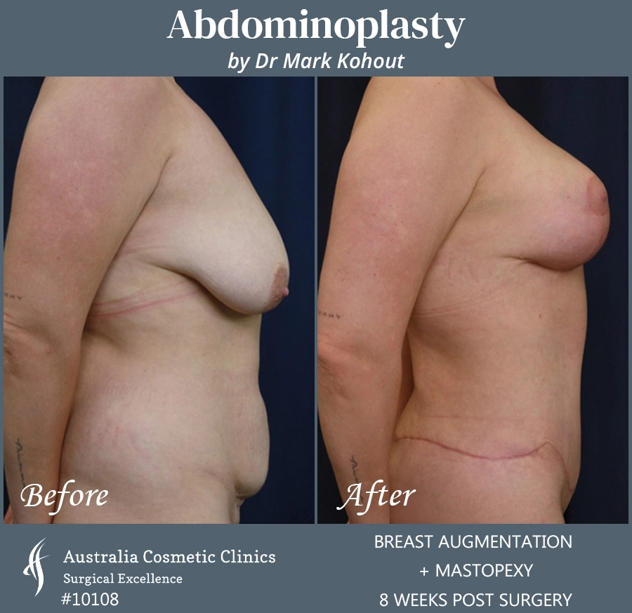 Abdominoplasty Patient 10108 Side