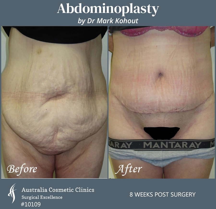 Abdominoplasty Patient 10109 Front