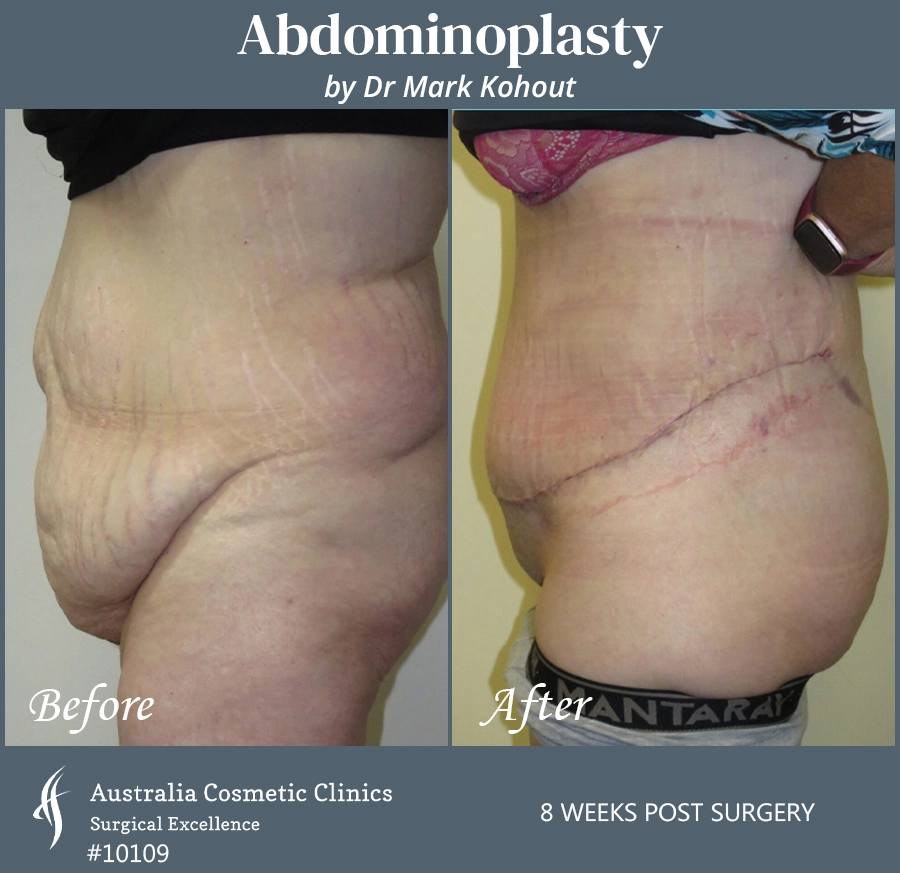 Abdominoplasty Patient 10109 Side