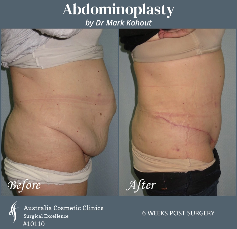 Abdominoplasty Patient 10110 Side