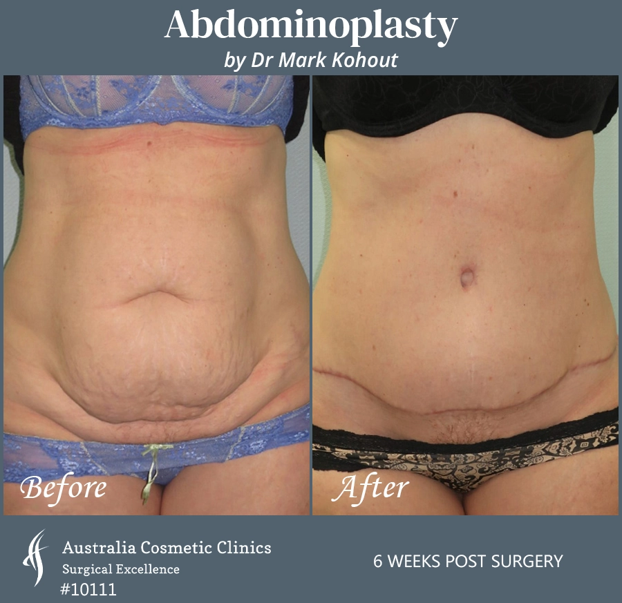 Abdominoplasty Patient 10111 Front