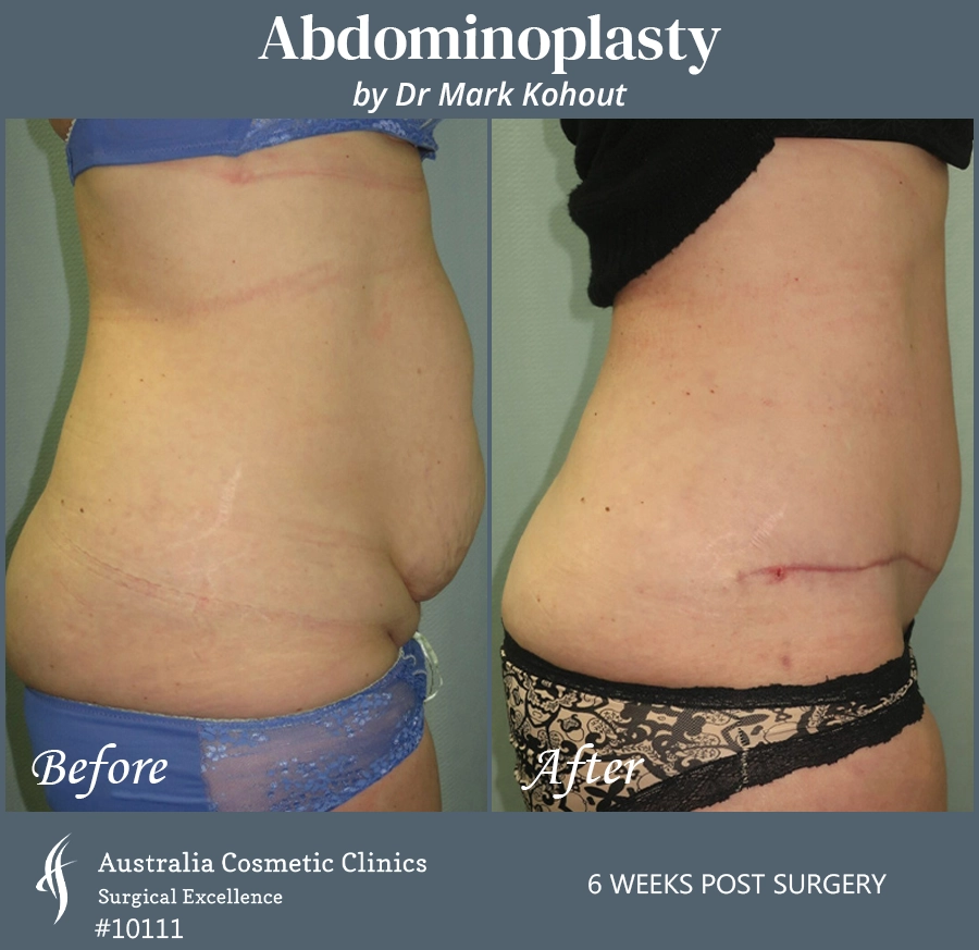 Abdominoplasty Patient 10111 Side