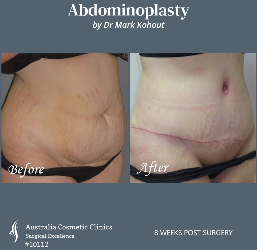 Abdominoplasty Patient 10112 45