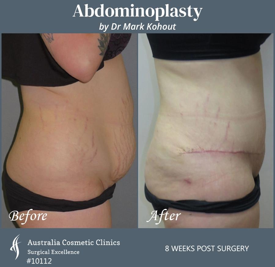 Abdominoplasty Patient 10112 Side