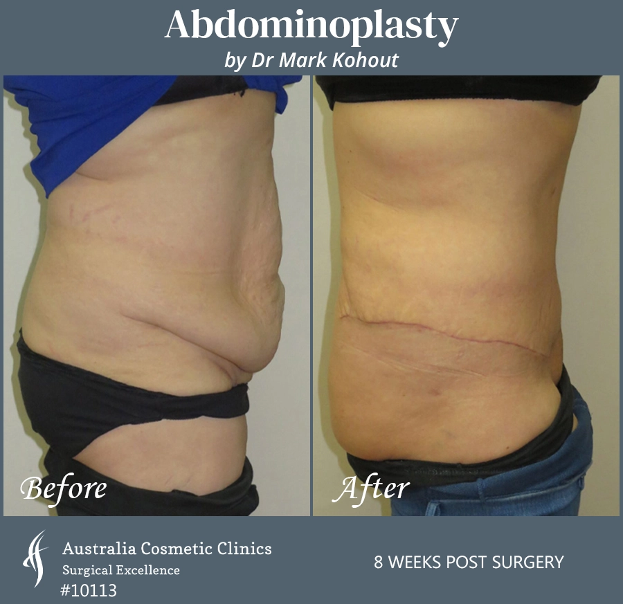 Abdominoplasty Patient 10113 Side