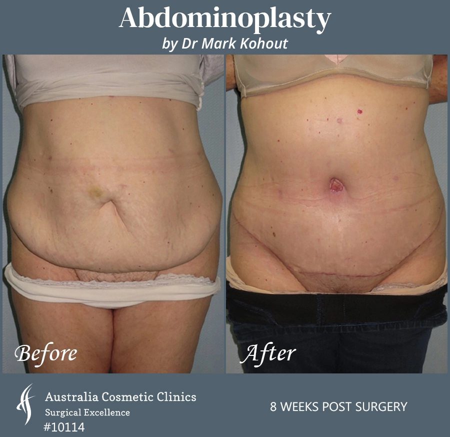 Abdominoplasty Patient 10114 Front