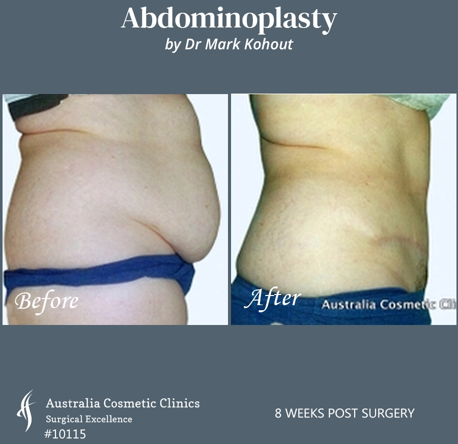Abdominoplasty Patient 10115 Side