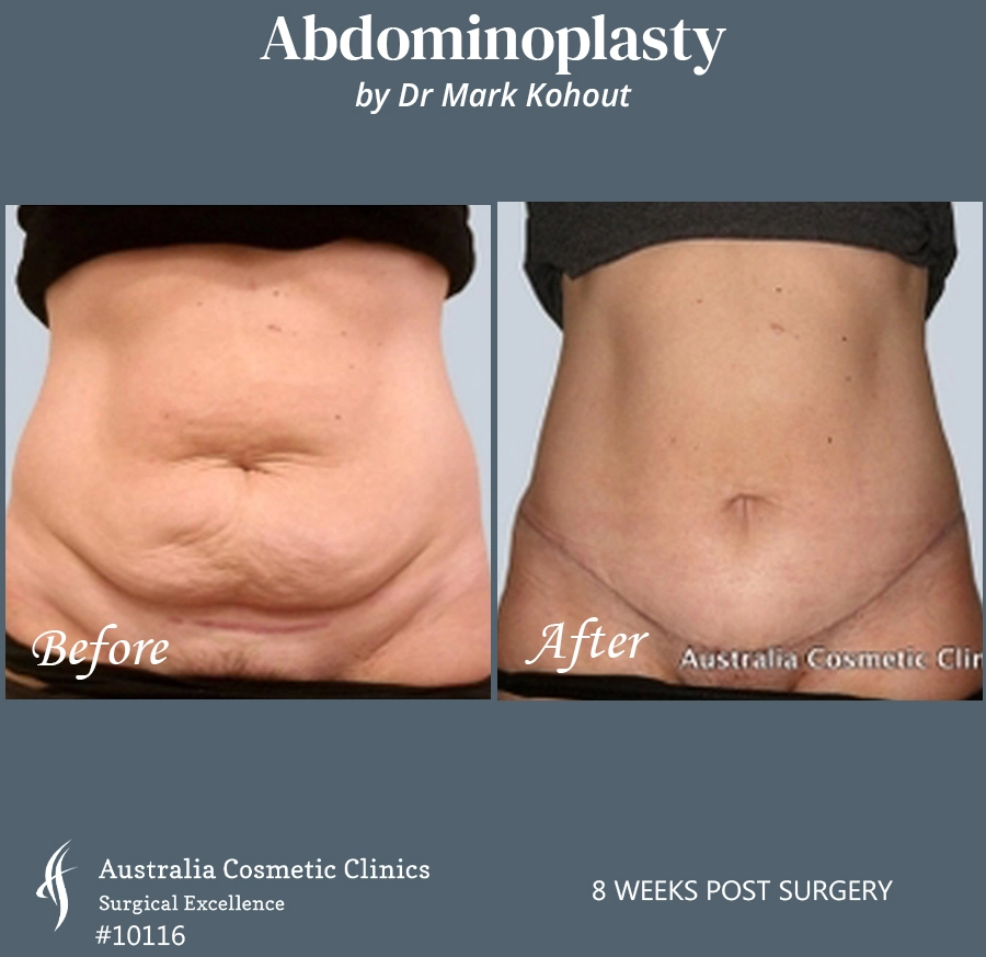 Abdominoplasty Patient 10116 Front
