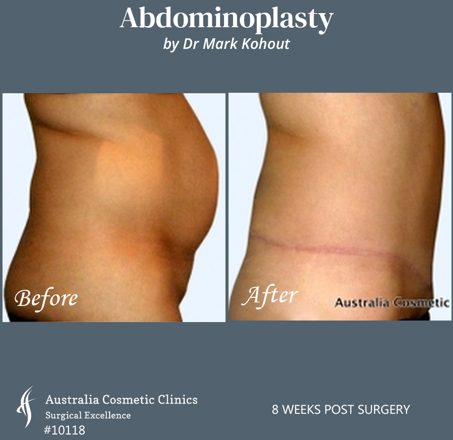 Abdominoplasty Patient 10118 Side