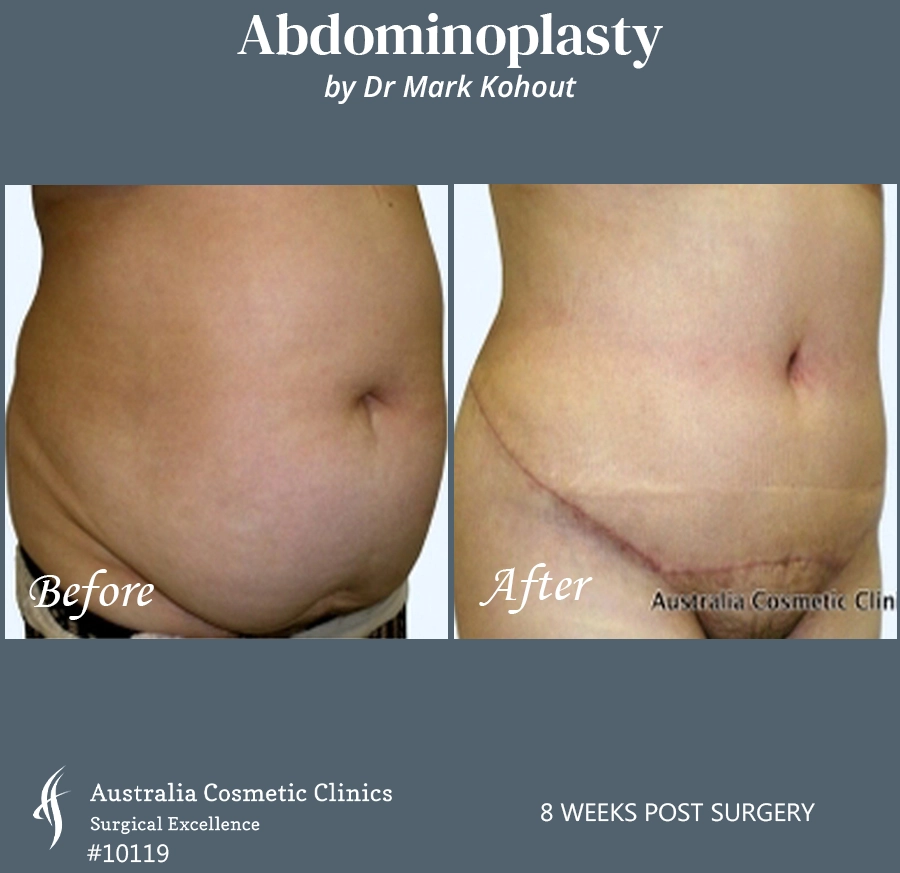 Abdominoplasty Patient 10119 45