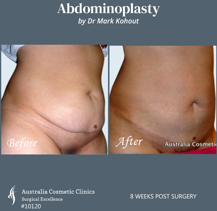 Abdominoplasty Patient 10120 45