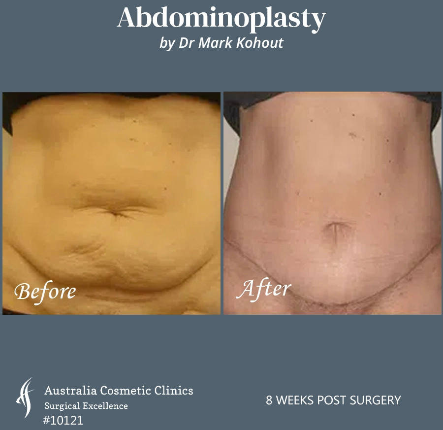 Abdominoplasty Patient 10121 Front