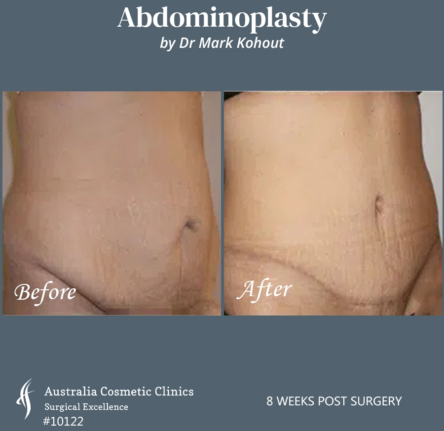 Abdominoplasty Patient 10122 45