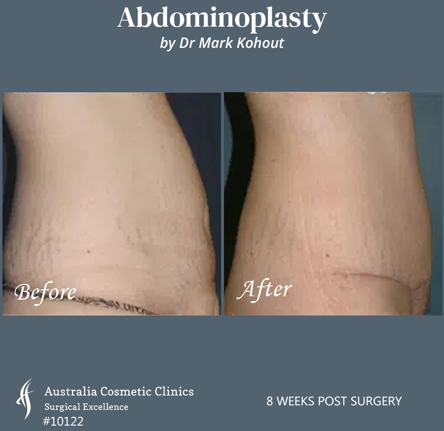 Abdominoplasty Patient 10122 Side