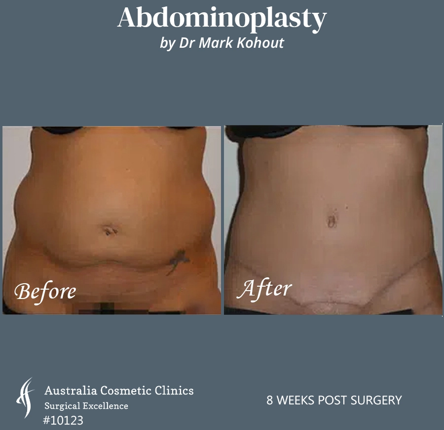 Abdominoplasty Patient 10123 Front