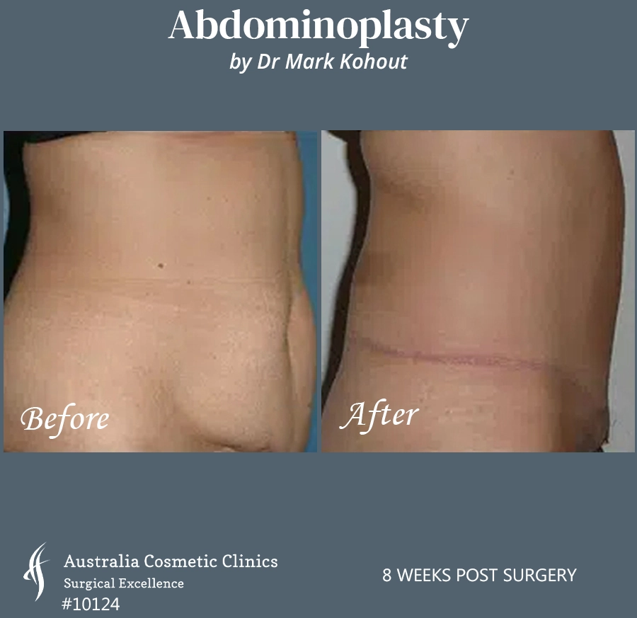 Abdominoplasty Patient 10124 Side
