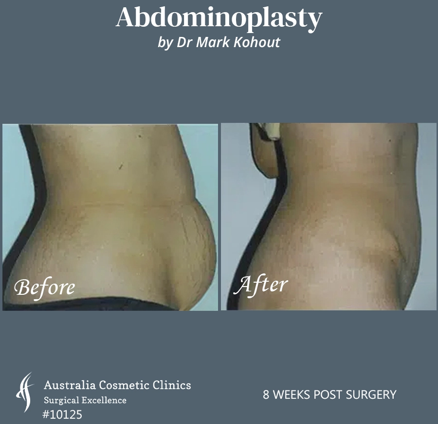 Abdominoplasty Patient 10125 Side