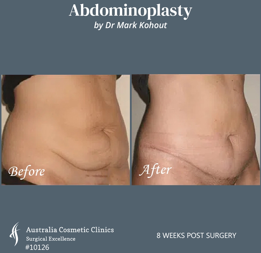 Abdominoplasty Patient 10126 45