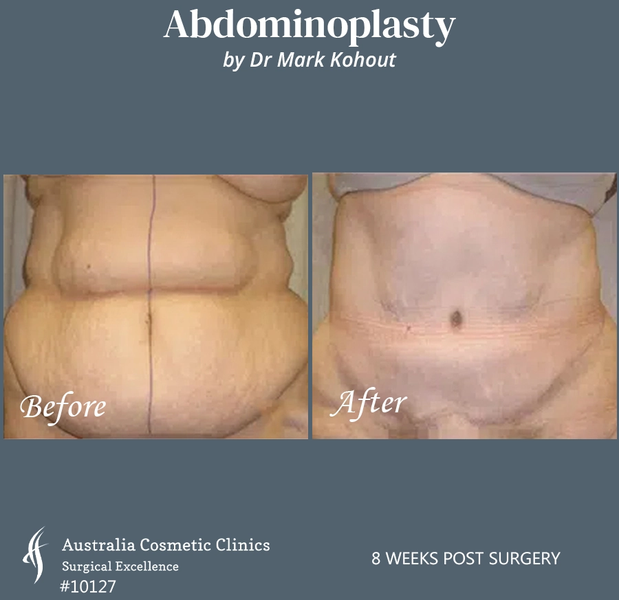 Abdominoplasty Patient 10127 Front