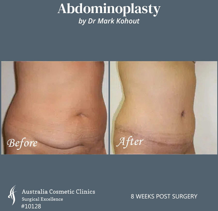 Abdominoplasty Patient 10128 45