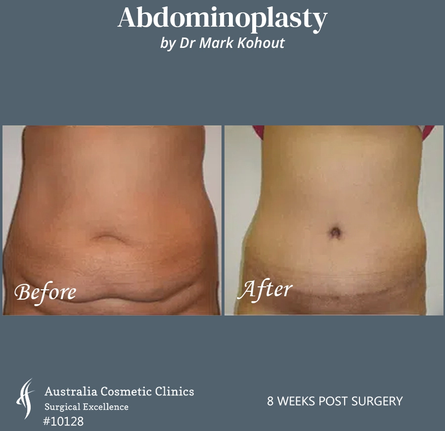 Abdominoplasty Patient 10128 Front