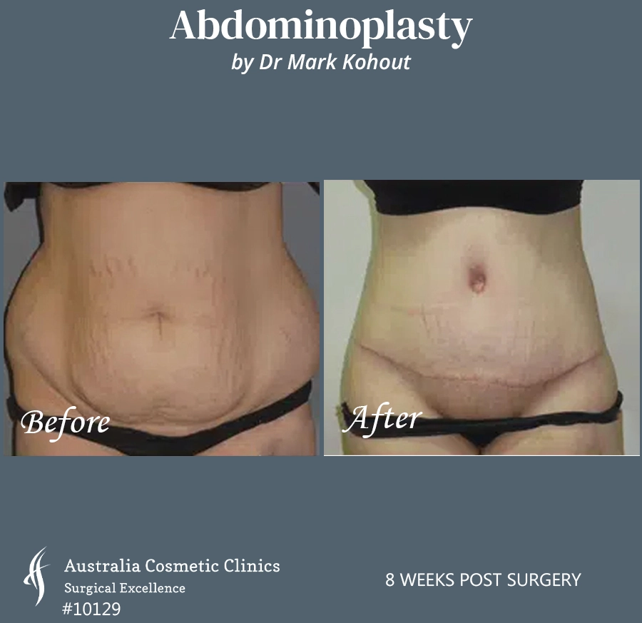 Abdominoplasty Patient 10129 Front