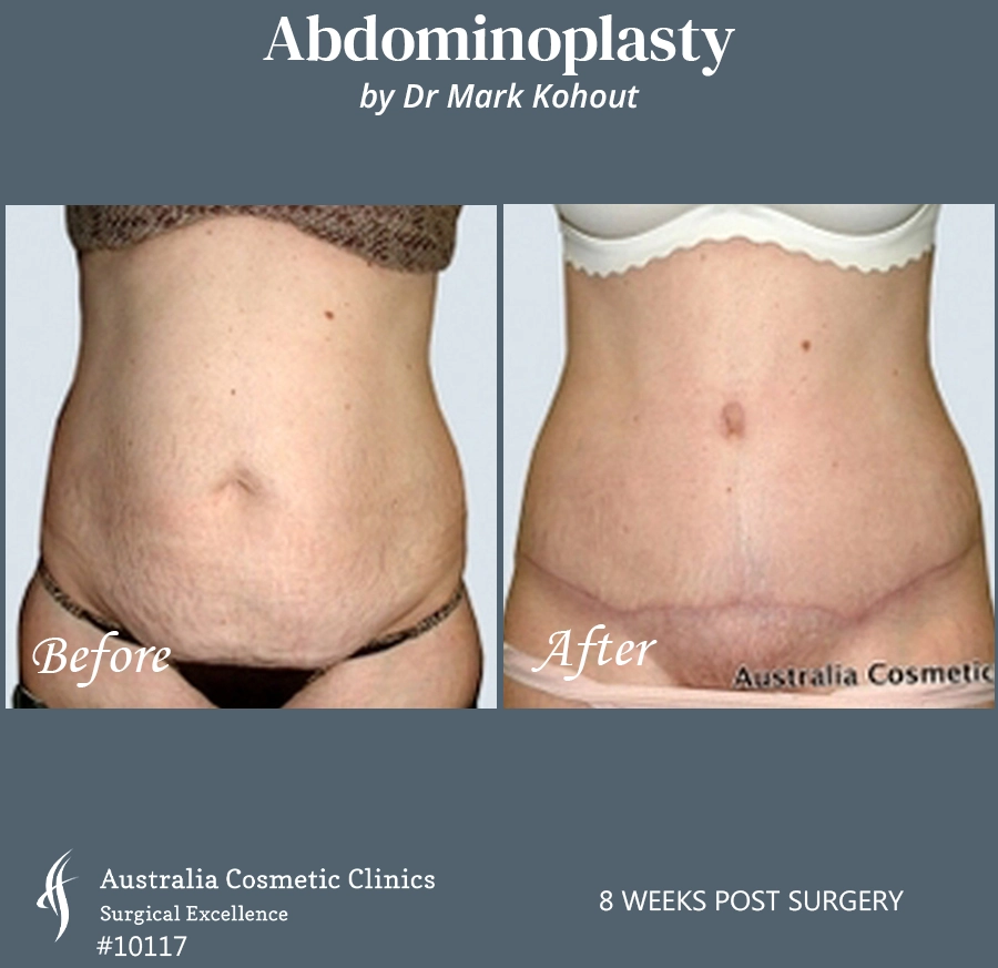 Abdominoplasty Patient 10117 Front